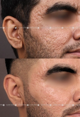 acne scars before and after laser treatment