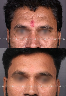 acne scars before and after microneedling