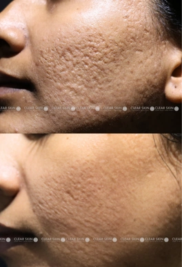 acne scars before and after photos
