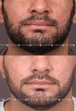 acne scars before and after pictures