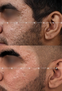 acne scars before and after