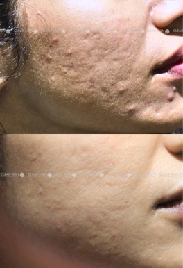 pico laser acne scars before and after