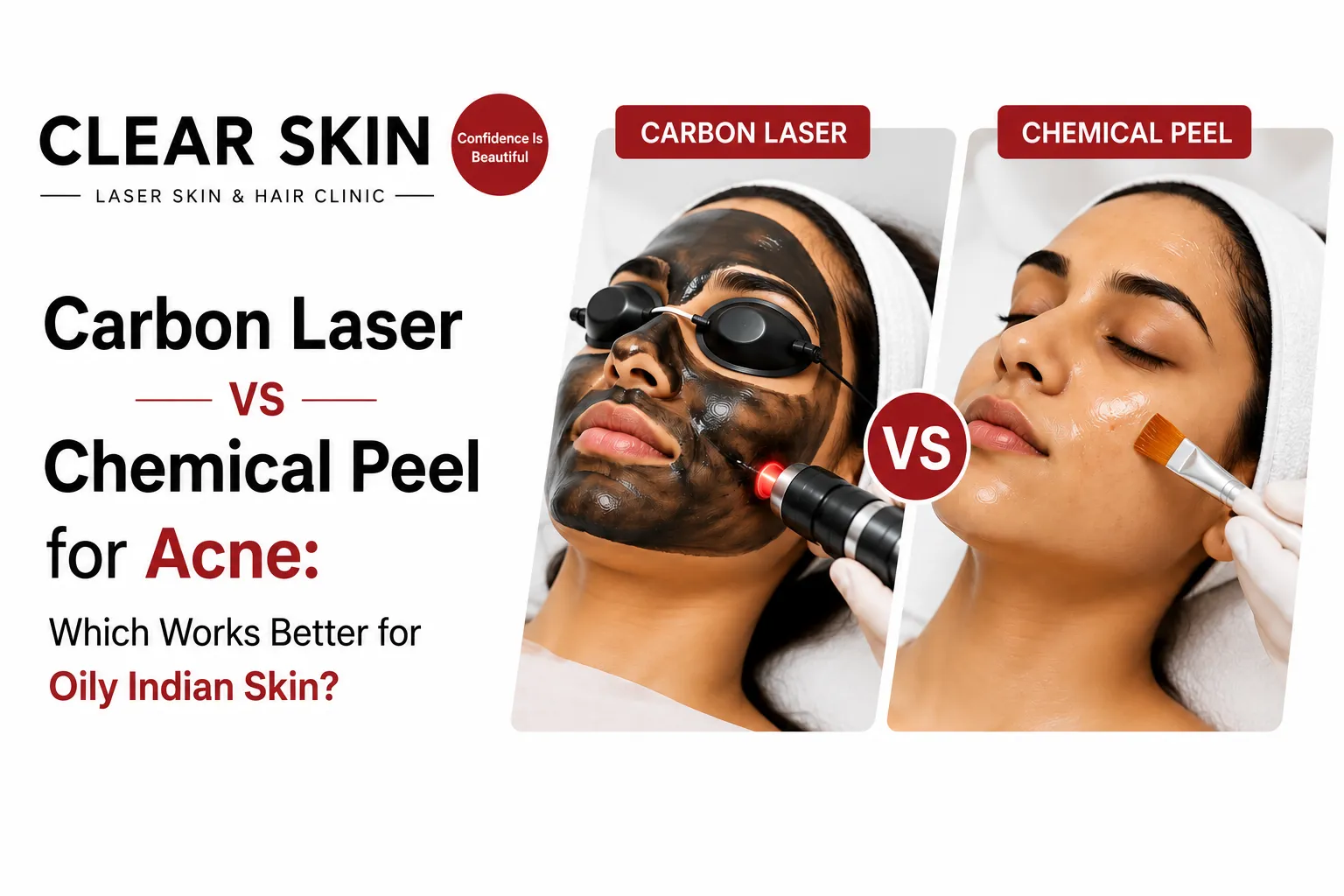 How Carbon Laser Peels Work for Acne