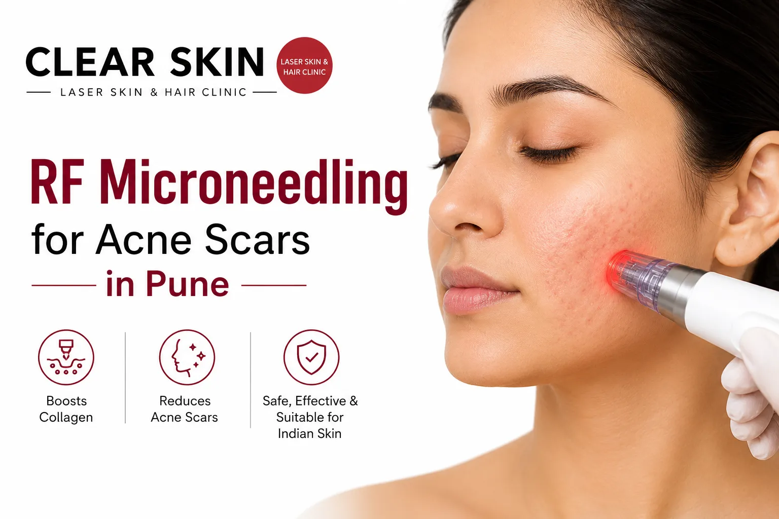 RF Microneedling for Acne Scars in Pune