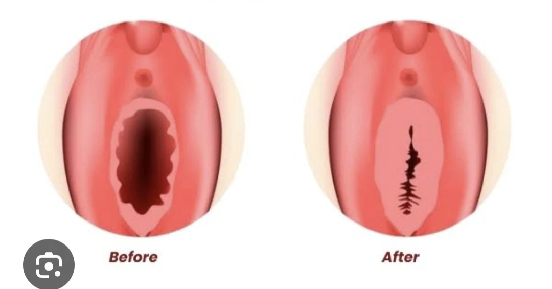 Hymenoplasty