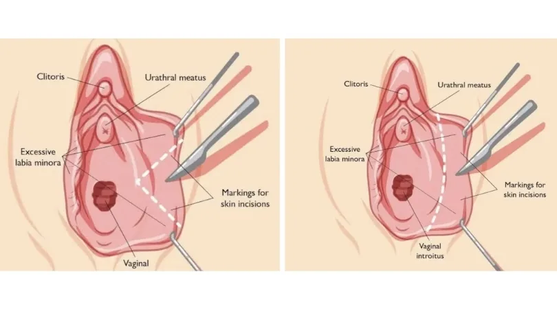 Labiaplasty
